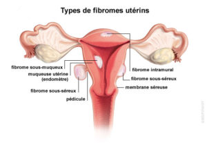 Types de fibromes