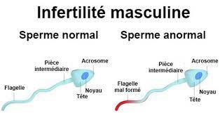 Infertilité masculine traitement naturel, veuillez découvrir cette tisane vraiment efficace pouvant vous guérir définitivement de votre mal