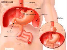 L’hernie hiatale: Causes, Symptômes, et Traitement Naturel