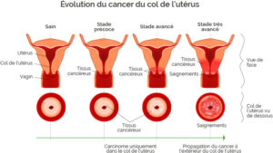 Le cancer du col de l'utérus