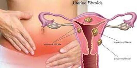 Fibrome de l’Utérus Remède Naturel Pour le Fibrome Utérin