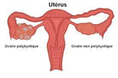 Remède Naturel Dystrophie Ovarienne, c'est un traitement naturel qui rétablit l'ovulation en qualité pour vous permettre de tomber enceinte