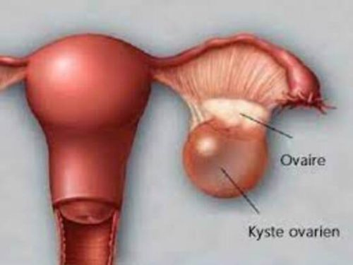 Kyste Ovarien Traitement Naturel, Nous vous proposons le meilleur remède pour vous faire soigner des kystes ovariens définitivement