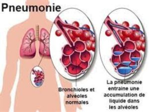 La Pneumonie