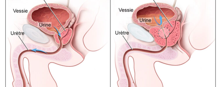 Le Traitement Naturel de l’Adénome de la Prostate
