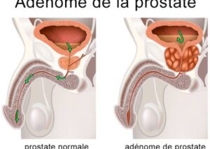 l’Adénome de la Prostate