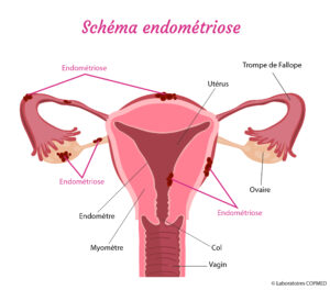 Schema-endometriose