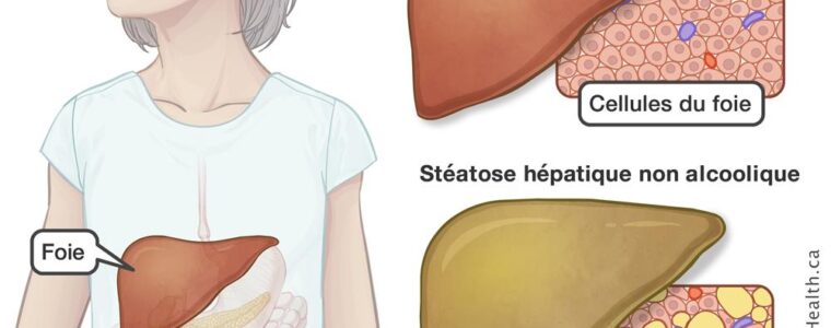 Stéatose Hépatique Recette Naturelle par les plantes. Ici je vous présente le traitement naturel pour soigner cette pathologie sans risque