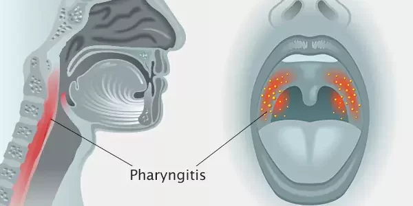 La Pharyngite Solution Naturelle par les plantes. Ici je vous présente la meilleur recette pour soigner la pharyngite sans effet secondaire