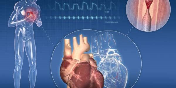 Cardiopathie Ischémique: C’est quoi, Quelle solution Naturelle
