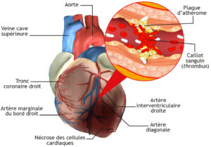 cardiopathie ischémique