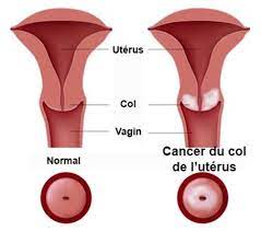 Cancer du Col de l’Utérus: Problème des Femmes, Syptômes et Solution Naturelle
