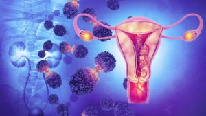 Cancer du col de l'utérus solution naturelle
