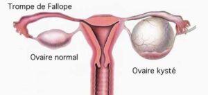 Comment Soigner Kyste Ovarien Naturellement