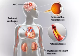 Comment soigner l'hypertension artérielle naturellement