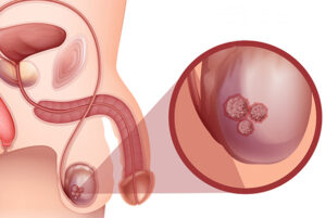 Comment soigner le kyste testiculaire naturellement