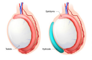 Soigner l'hydrocèle vaginale naturellement