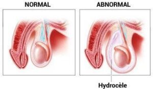 Hydrocèle vaginale solution naturelle