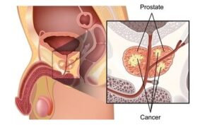 Cancer de la prostate recette naturelle
