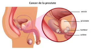 Cancer de la prostate solution naturelle