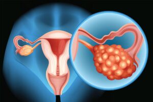 Cancer de l'ovaire solution naturelle