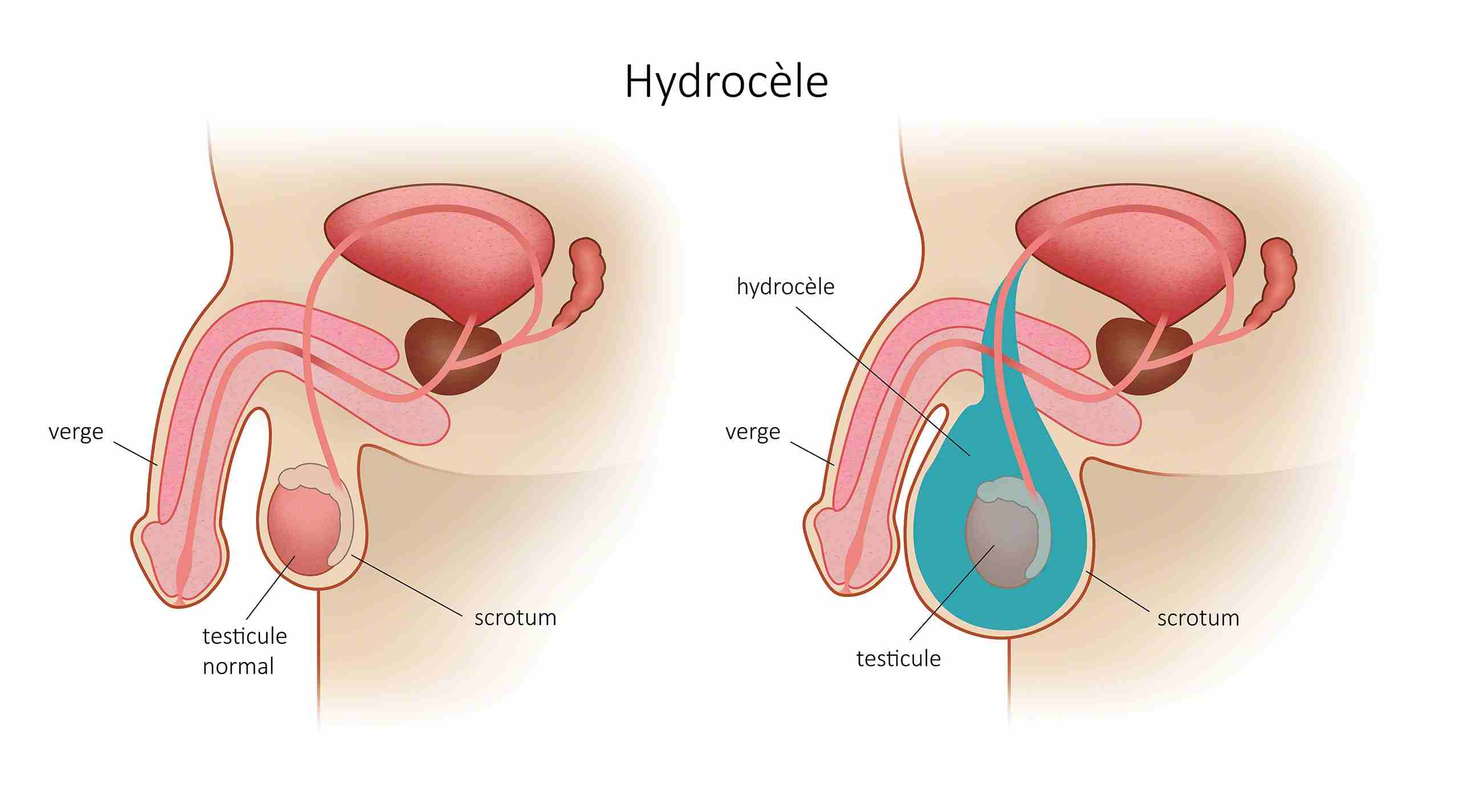 Hydrocèle vaginale solution naturelle