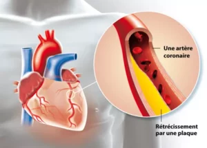 l'Angine de poitrine solution naturelle