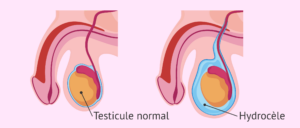 Hydrocèle vaginale recette naturelle