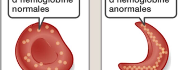 Qu’est-ce que La Drépanocytose ? Causes et Traitement Naturel