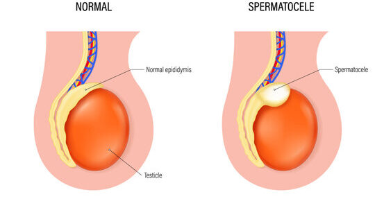 Comment traiter le spermatocèle naturellement ?