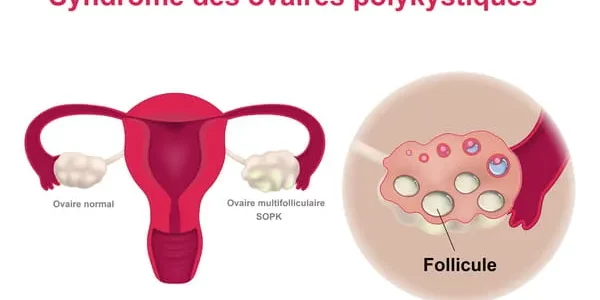 Syndrome des ovaires polykystique solution naturelle