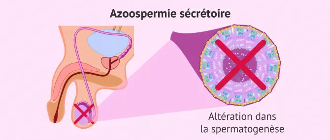 Azoospermie sécrétoire soin naturel