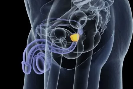 Soin naturel du cancer de prostate