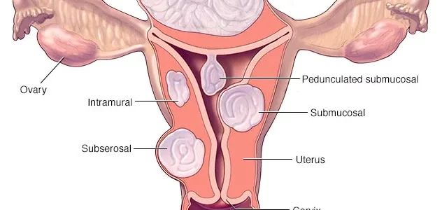 Fibrome : Définition, Causes, Symptômes Et Soin Naturel Par Les Plantes