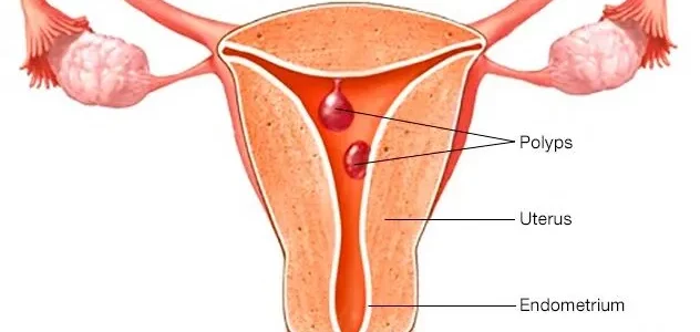 L’endométriose : Définition, Causes, Symptômes Et Recette Naturelle